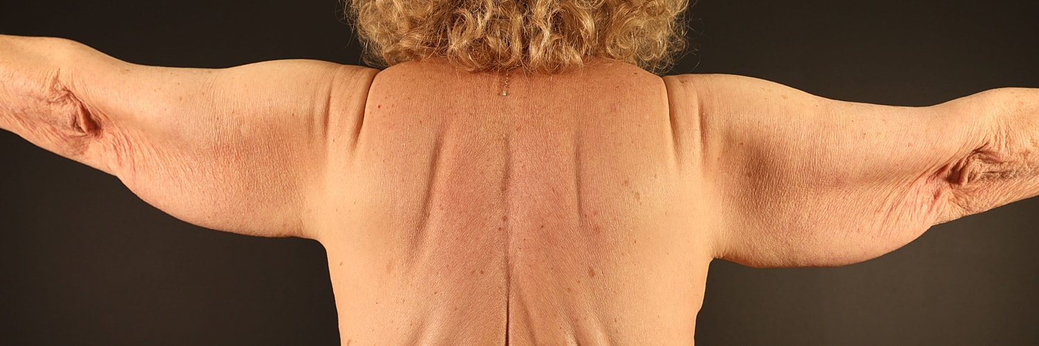 Brachioplasty Before & After