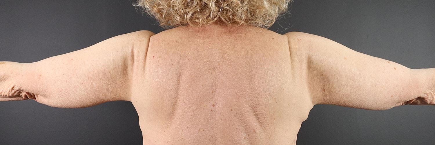 Brachioplasty Before & After