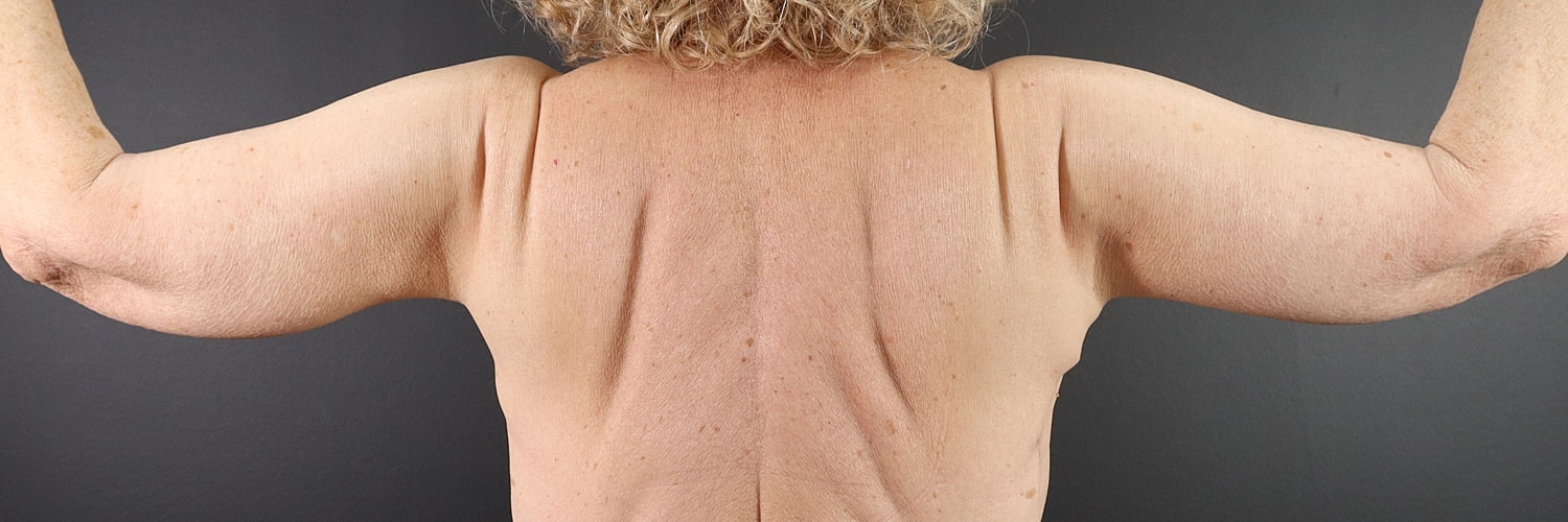 Brachioplasty Before & After