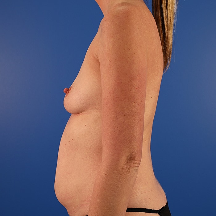 Mommy Makeover Before & After