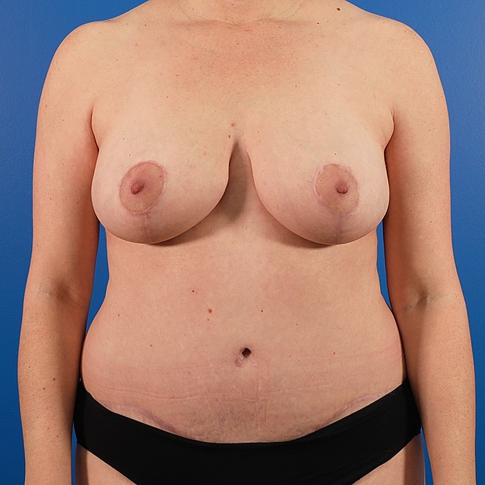 Mommy Makeover Before & After