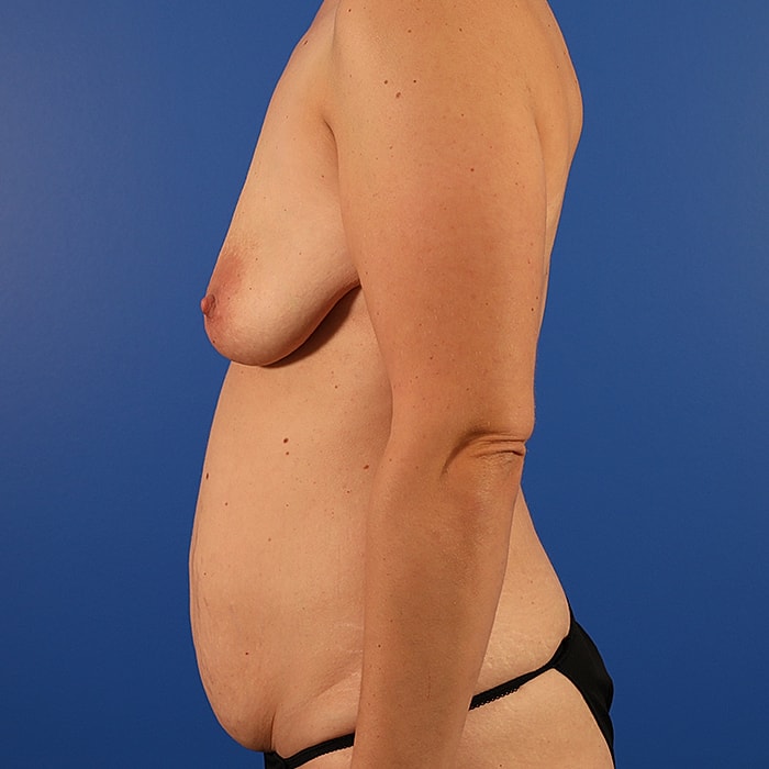 Mommy Makeover Before & After