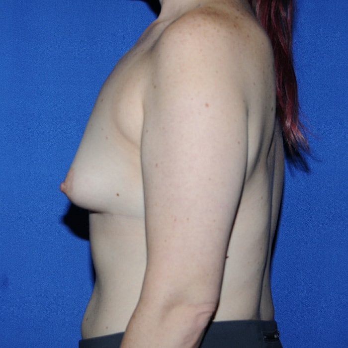 Breast Asymmetry Before & After
