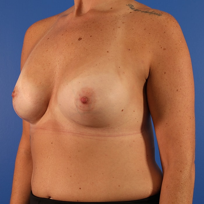 Breast Asymmetry Before & After