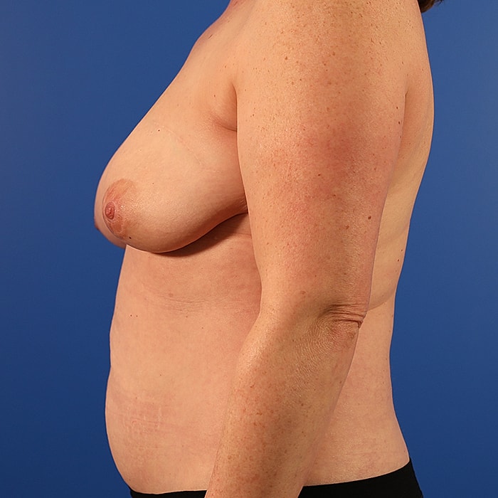 Breast Asymmetry Before & After