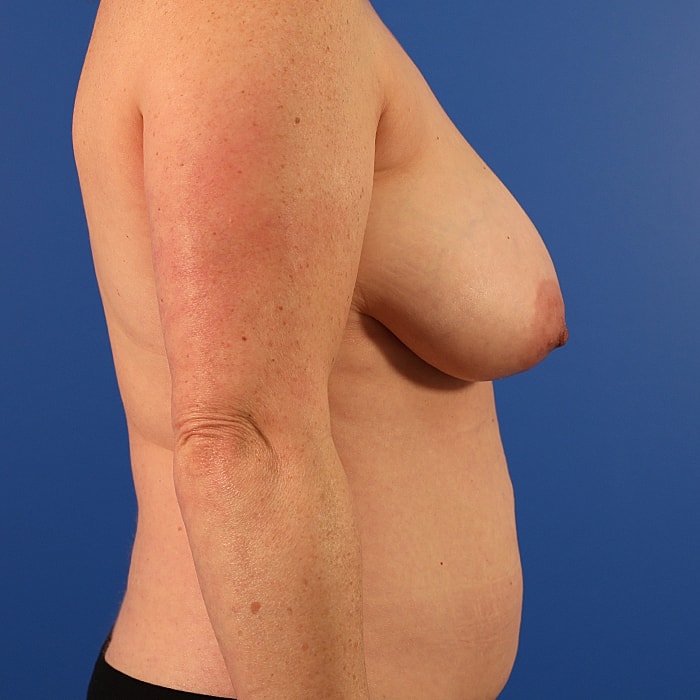 Breast Asymmetry Before & After