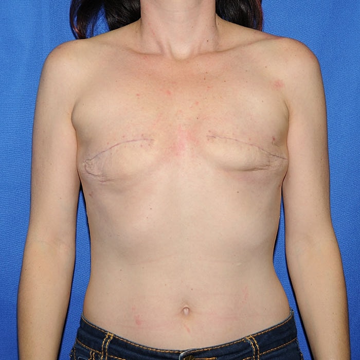 Implant Based Reconstruction Before & After