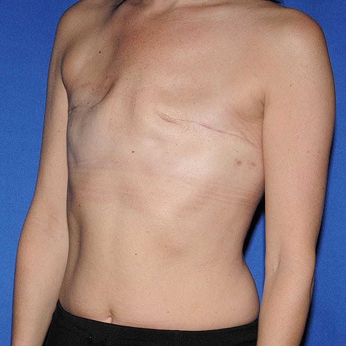 Implant Based Reconstruction Before & After