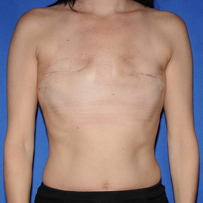 Implant Based Reconstruction Before & After
