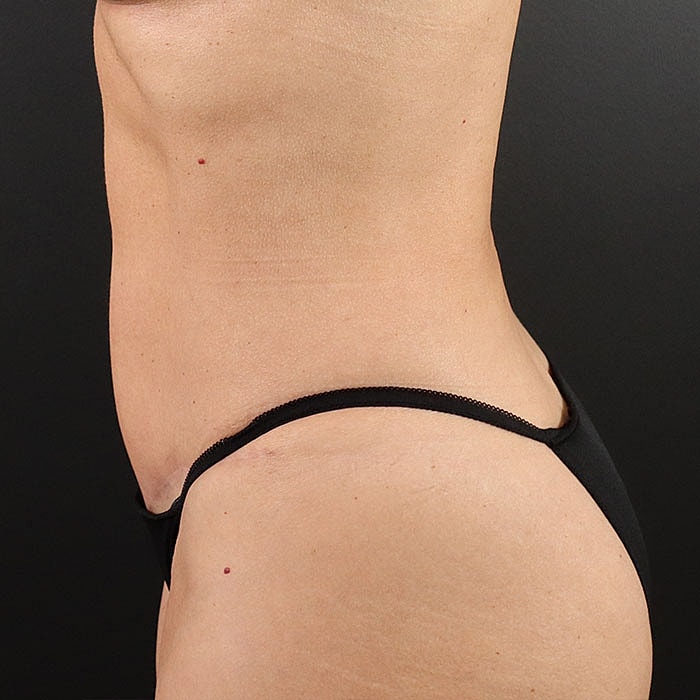 Abdominoplasty Before & After