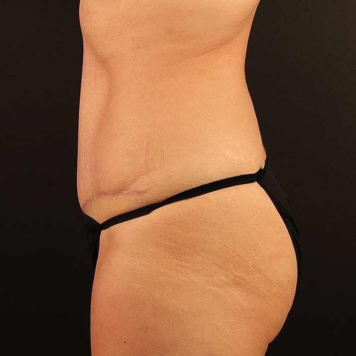 Abdominoplasty Before & After