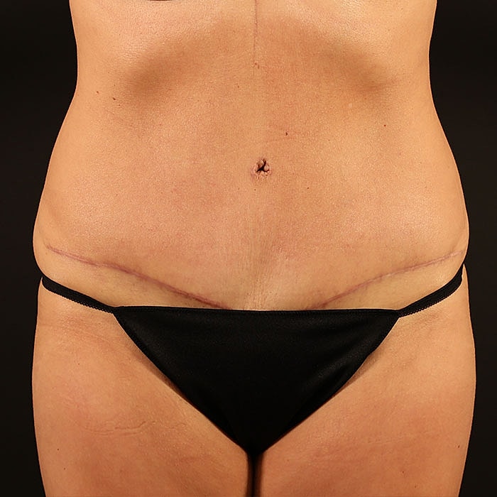 Abdominoplasty Before & After