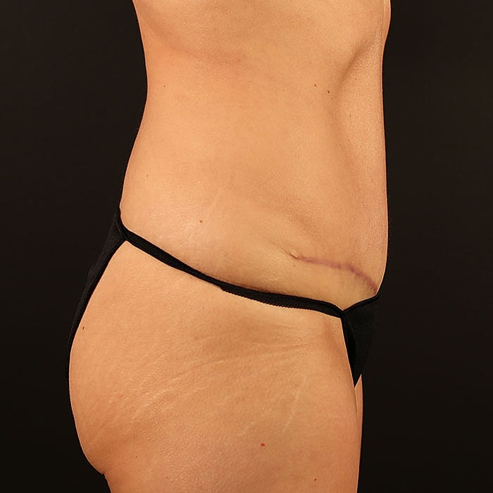 Abdominoplasty Before & After