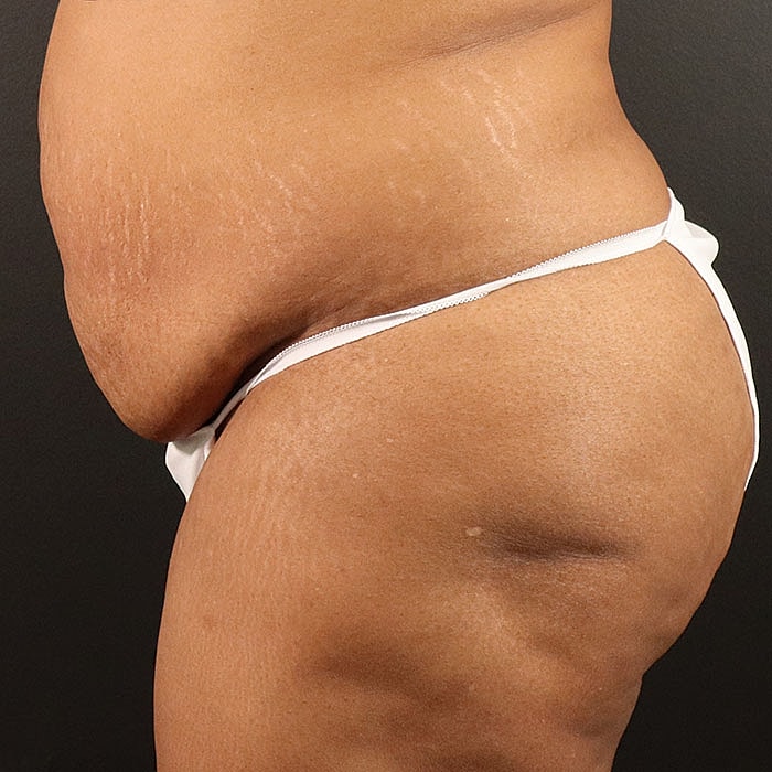 Abdominoplasty Before & After