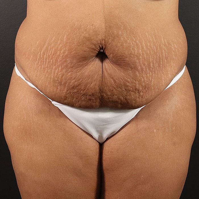 Abdominoplasty Before & After