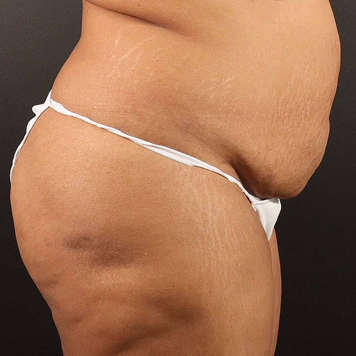 Abdominoplasty Before & After