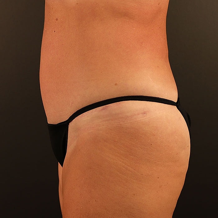 Abdominoplasty Before & After