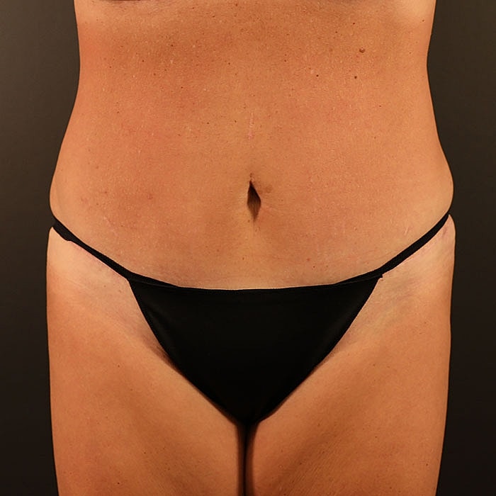 Abdominoplasty Before & After