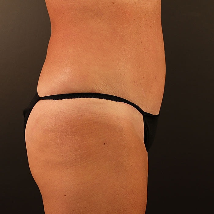 Abdominoplasty Before & After