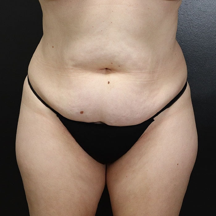 Abdominoplasty Before & After