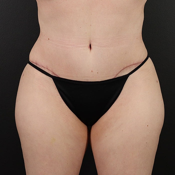 Abdominoplasty Before & After