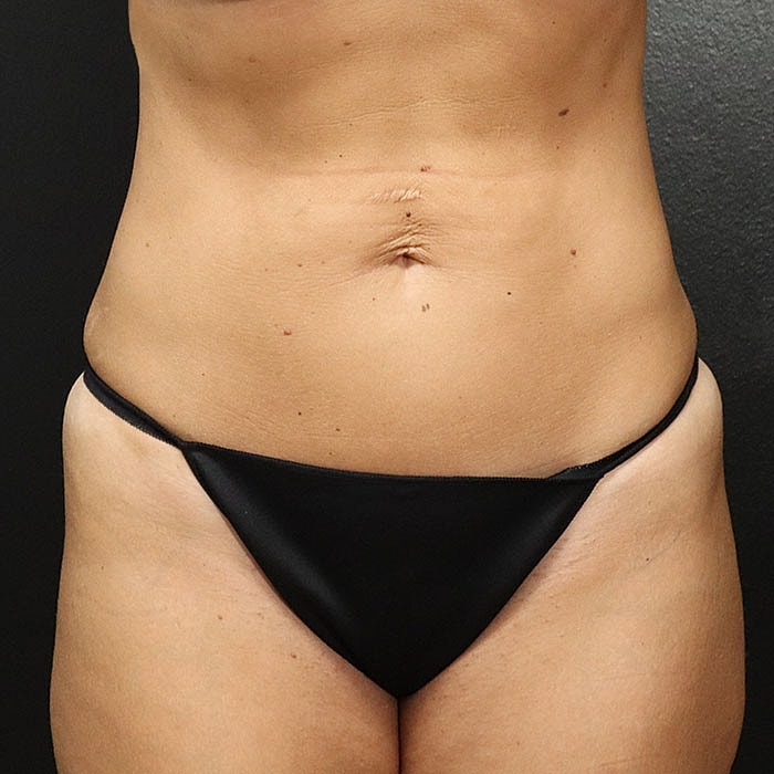 Abdominoplasty Before & After