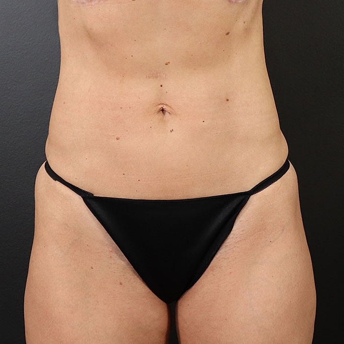 Abdominoplasty Before & After