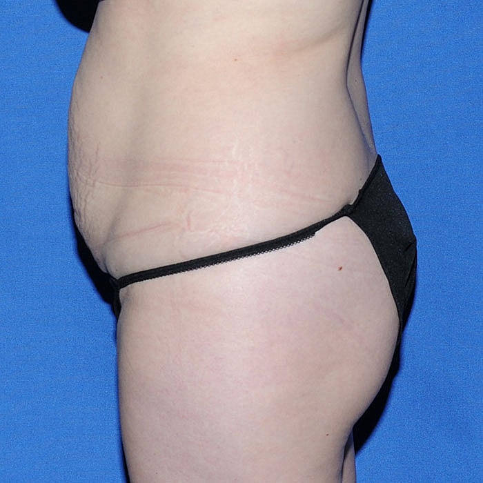 Abdominoplasty Before & After