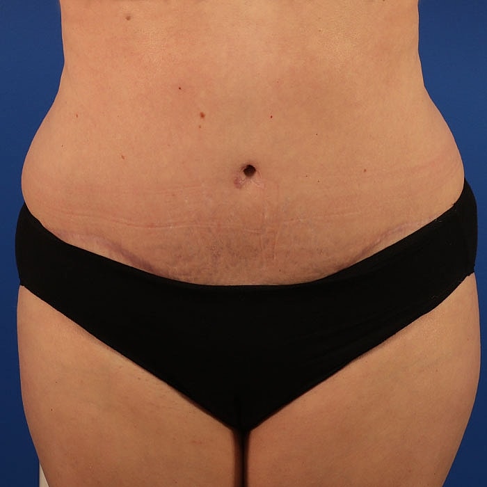 Abdominoplasty Before & After