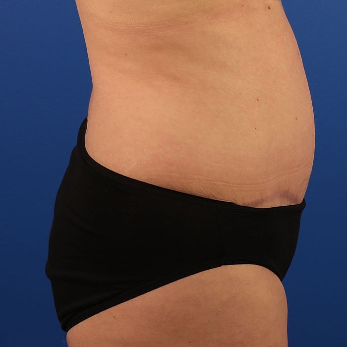 Abdominoplasty Before & After