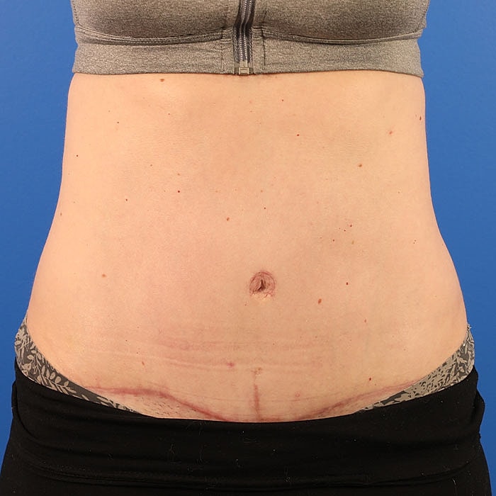 Abdominoplasty Before & After