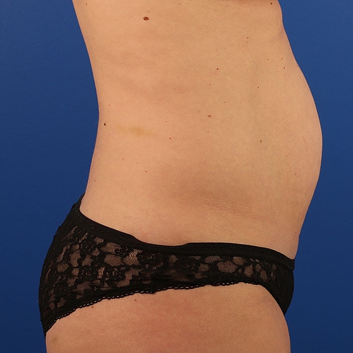 Abdominoplasty Before & After