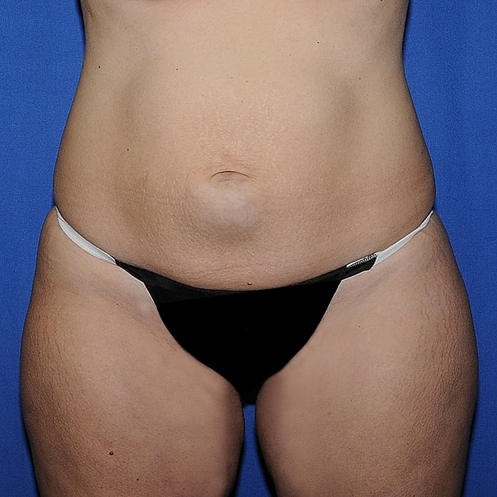 Abdominoplasty Before & After