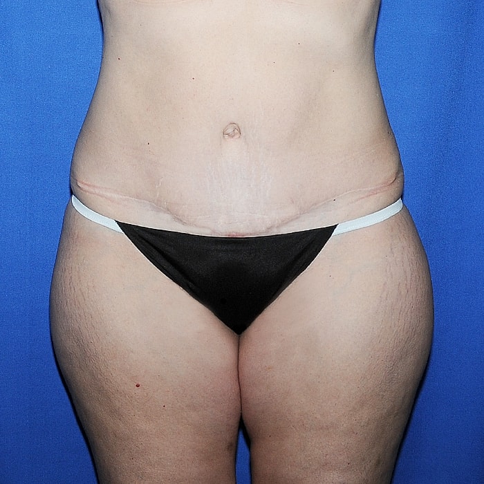 Abdominoplasty Before & After