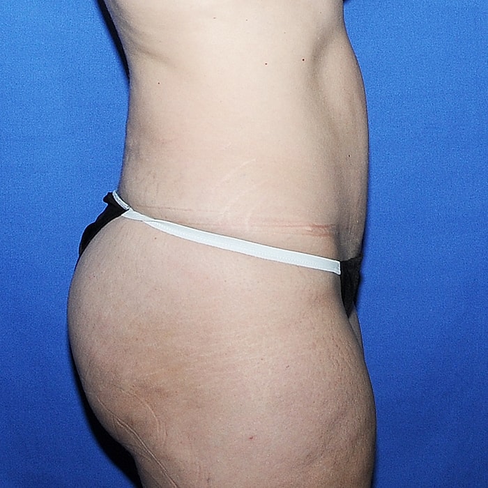 Abdominoplasty Before & After