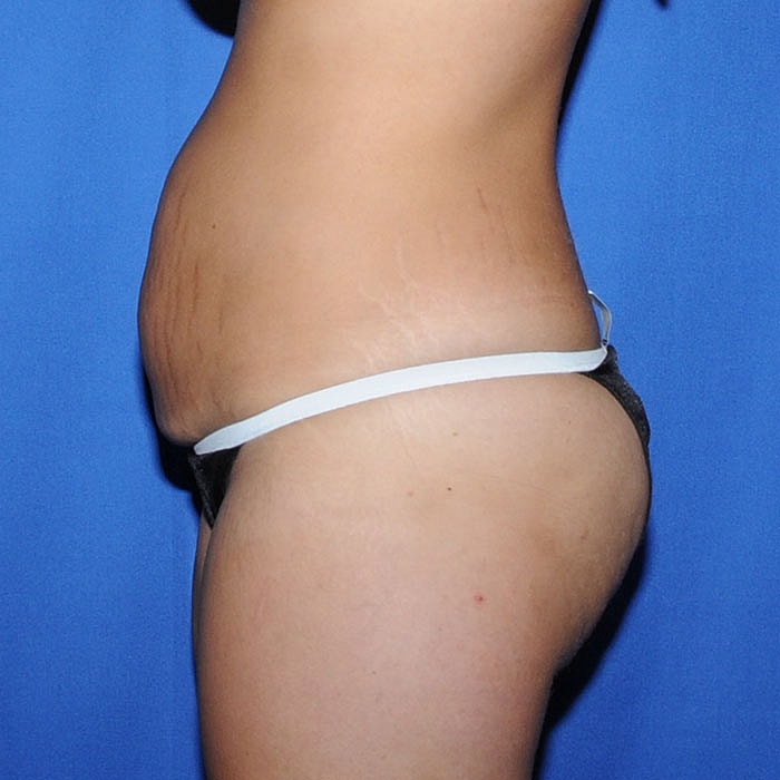 Abdominoplasty Before & After