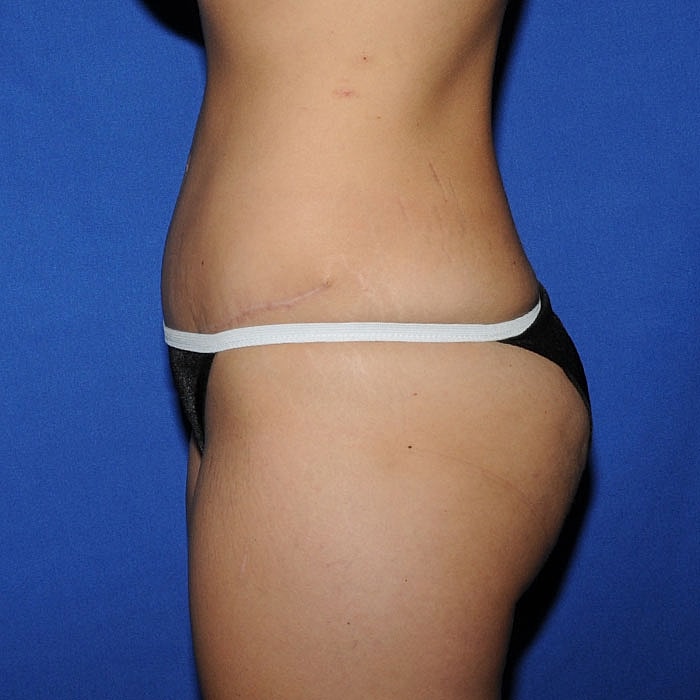 Abdominoplasty Before & After