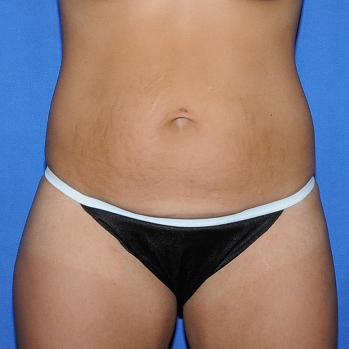 Abdominoplasty Before & After