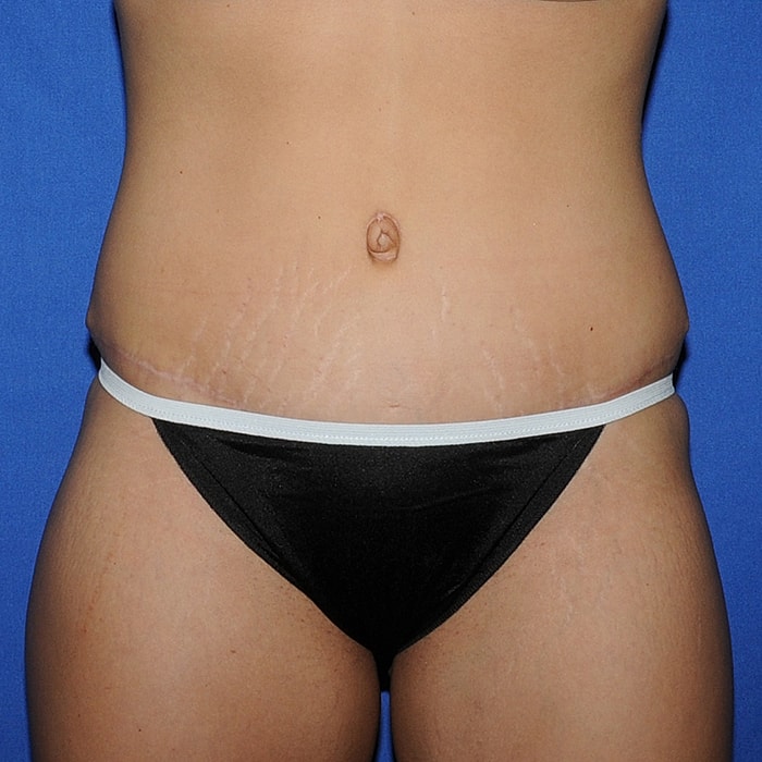 Abdominoplasty Before & After