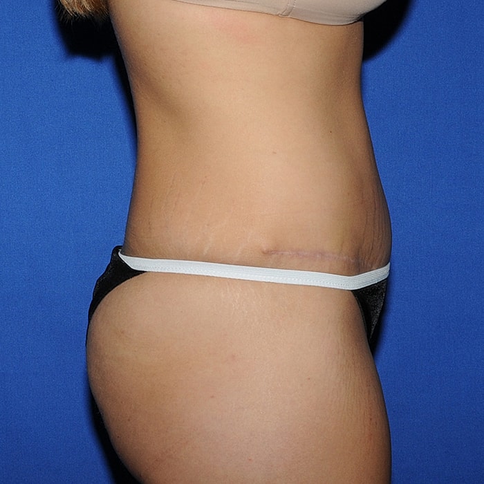 Abdominoplasty Before & After