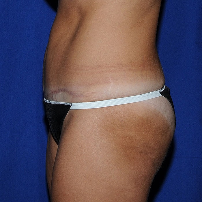 Abdominoplasty Before & After
