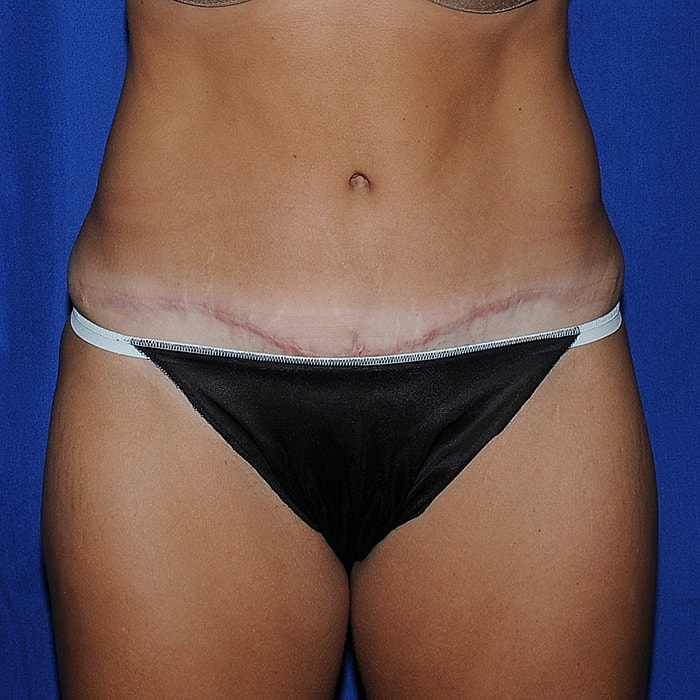 Abdominoplasty Before & After