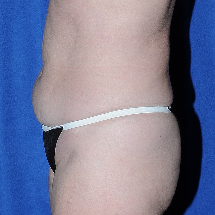 Abdominoplasty Before & After