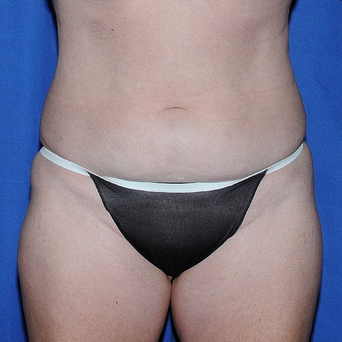 Abdominoplasty Before & After