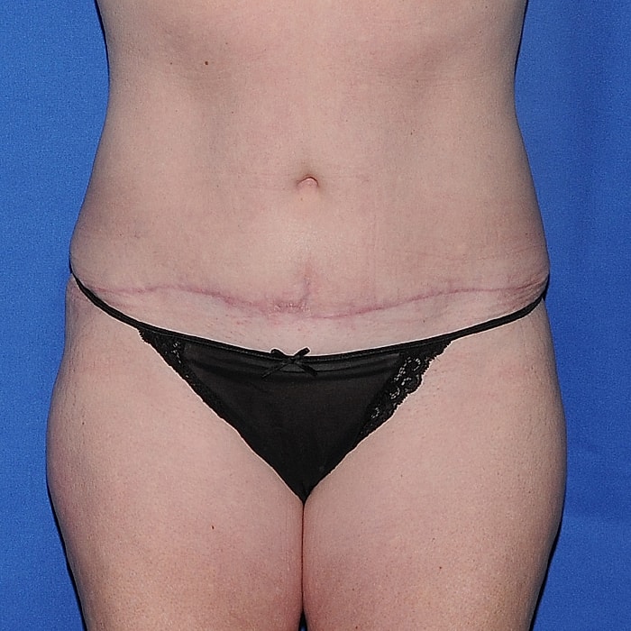 Abdominoplasty Before & After