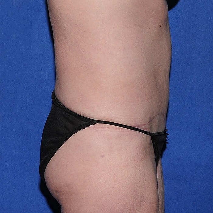 Abdominoplasty Before & After