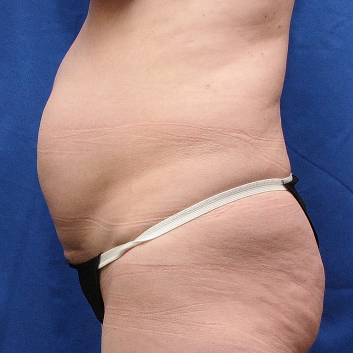 Abdominoplasty Before & After