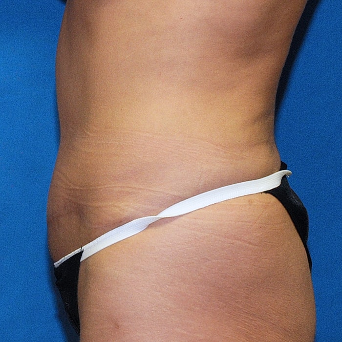 Abdominoplasty Before & After