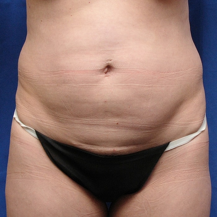 Abdominoplasty Before & After