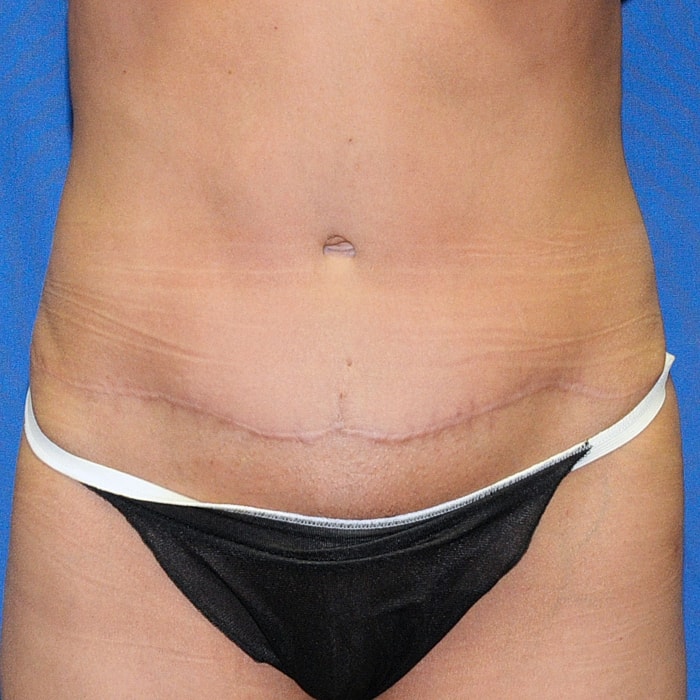 Abdominoplasty Before & After